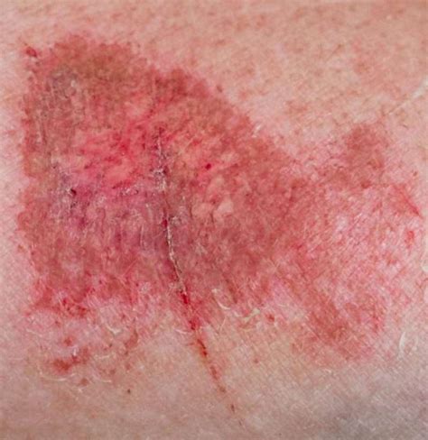 friction burn on shaft|pictures of friction blisters on foreskin.